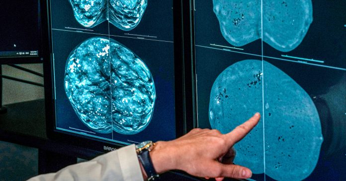 When should you get a mammogram? Conflicting advice makes it hard to know