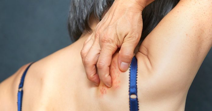 Shingles is linked to inflammation in the brain. Research shows how to cut dementia risk.