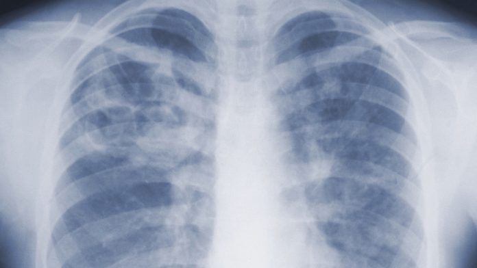 Study suggests the threat of mold-associated illnesses may be underappreciated